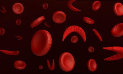 High-water content fruits, vegetables good for sickle cell patients