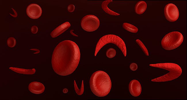 High-water content fruits, vegetables good for sickle cell patients
