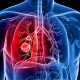 Scientists discover how air pollution triggers lung cancer