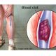 Lagos sensitises residents to thrombosis, warns against inactivity