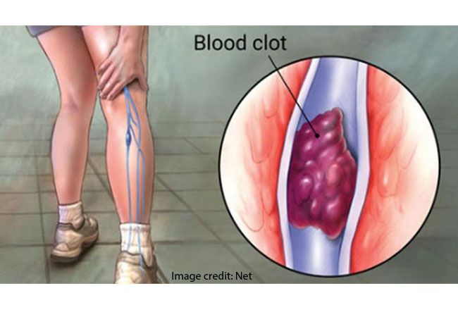 Lagos sensitises residents to thrombosis, warns against inactivity