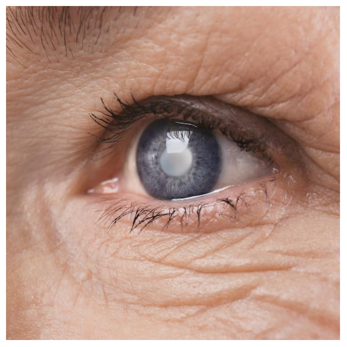 How to prevent sudden blindness from glaucoma —Ophthalmologists