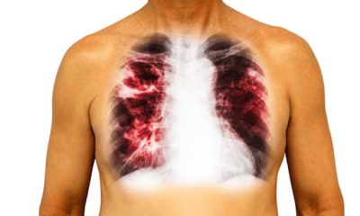 Anambra detects 8,000 tuberculosis cases in 2022 