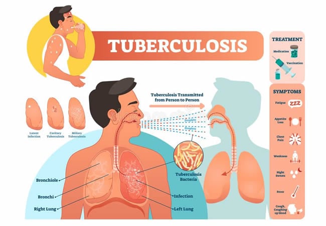 Experts differ on FG’s commitment to ending tuberculosis