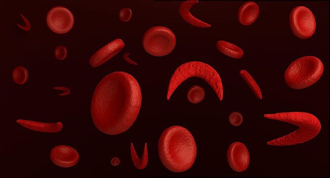 Sickle cell and enhancing your health (I)