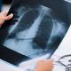 Can AI predict your 'true' age and how long you'll live using just chest X-rays?