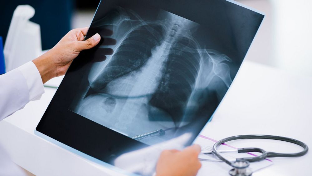 Can AI predict your 'true' age and how long you'll live using just chest X-rays?