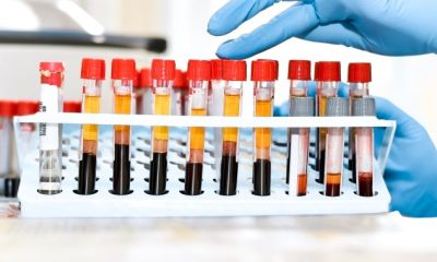 A blood test to detect Alzheimer’s disease? Here’s how it may look - National