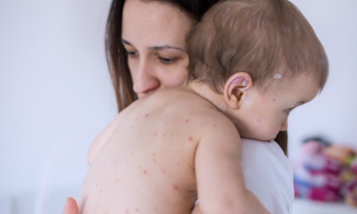 Manitoba experts ‘worried’ as uptake of measles vaccine drops 3 per cent - Winnipeg