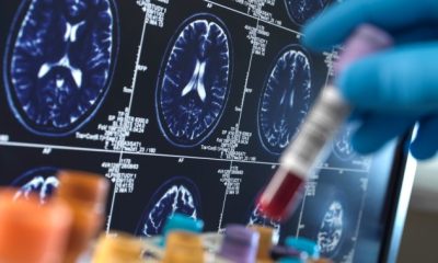 Neurological conditions affect 3.4B people worldwide. What about Canada? - National