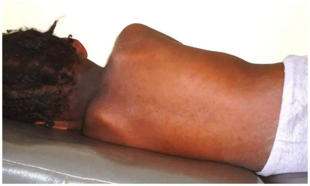 Measles complications kill 19 children in Adamawa